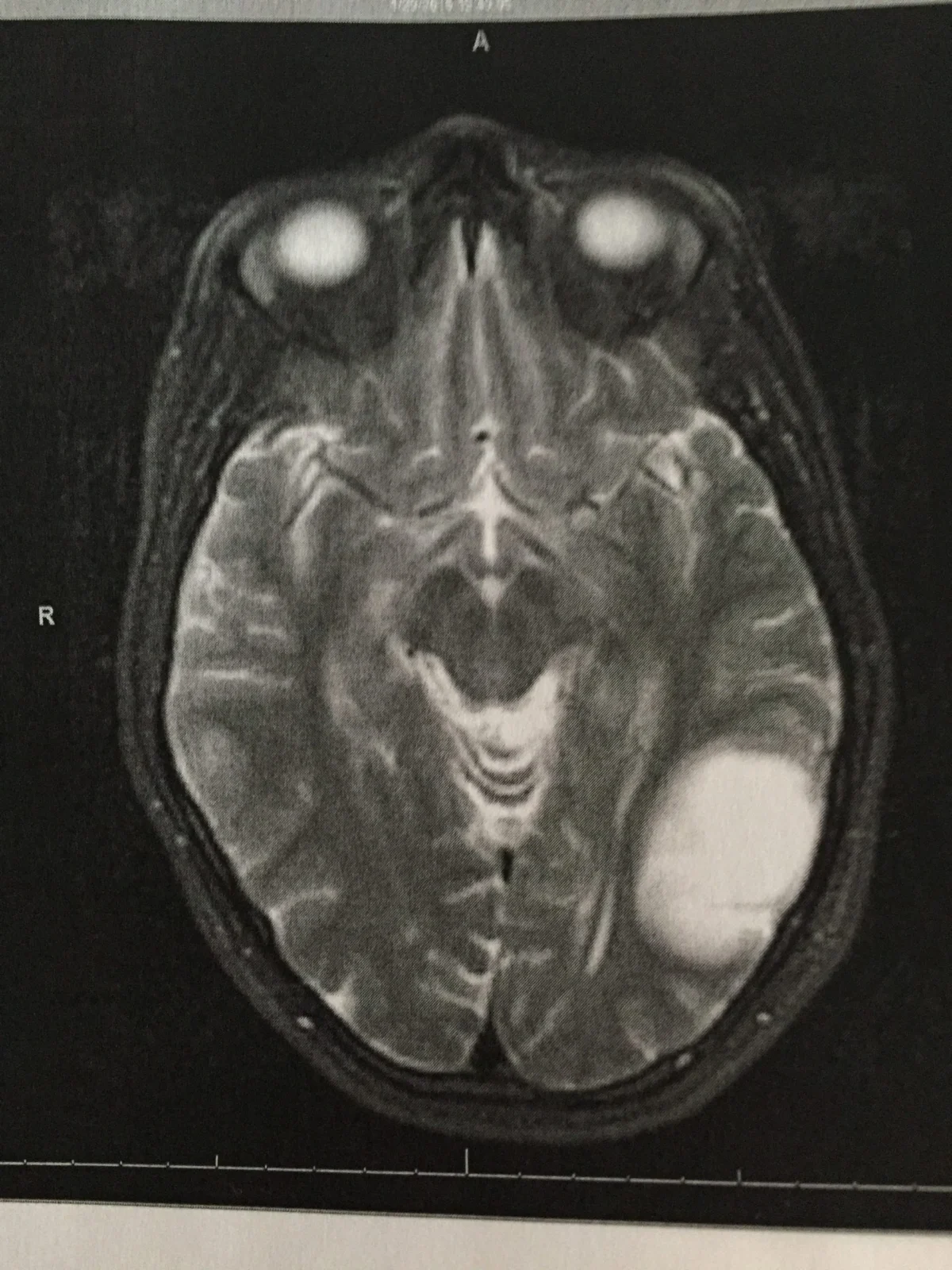 A Mother's Fight: How One Family Found Hope and Advocacy in the Battle Against Brain Tumors 1 a mothers fight how one family found hope and advocacy in the battle against brain tumors