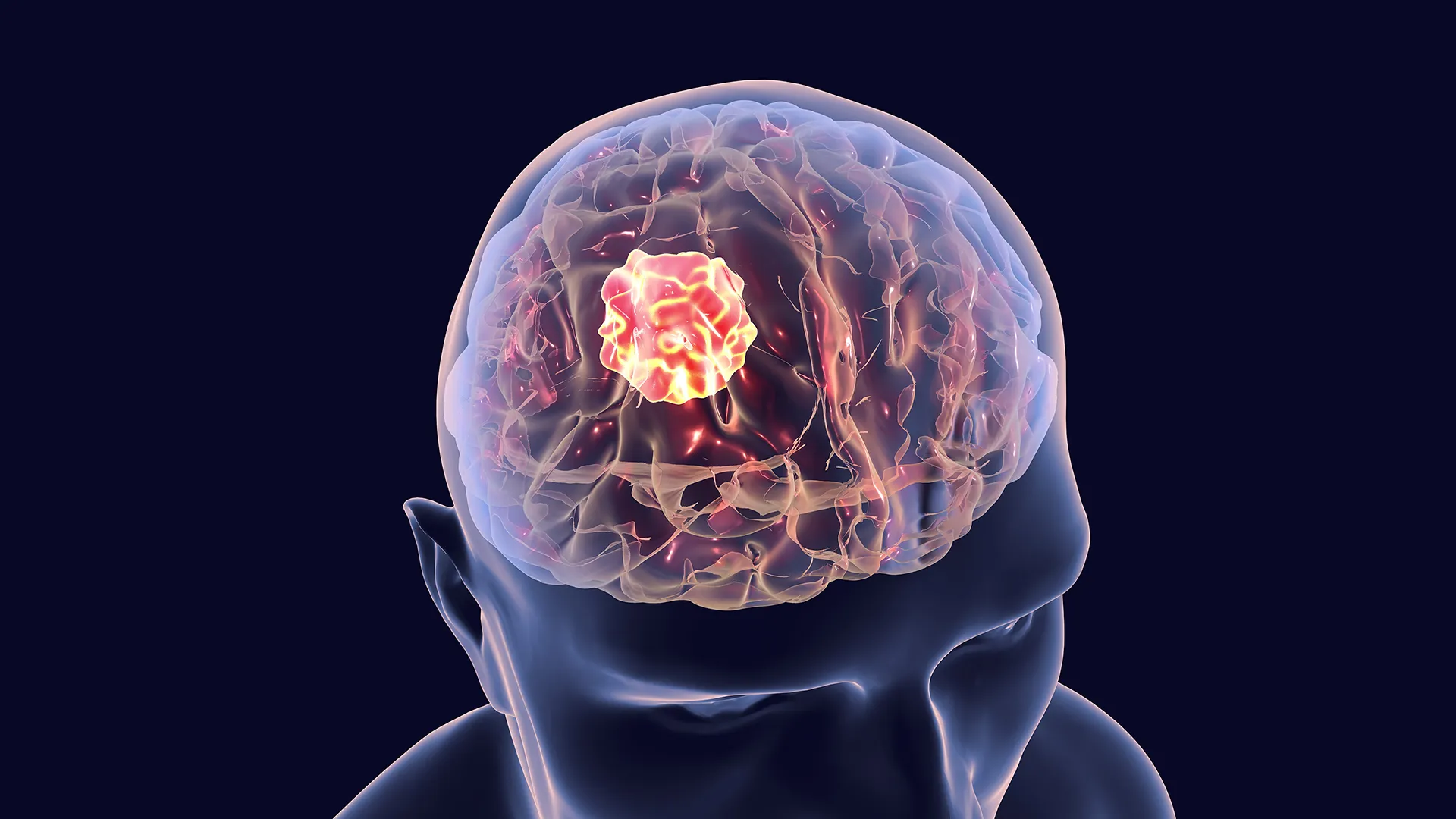 a promising new combination therapy shows potential to significantly extend survival for glioblastoma patients