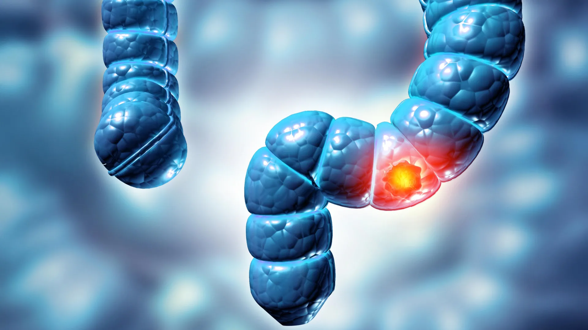 flinders university researchers uncover critical link between dual bowel polyps and significantly elevated cancer risk