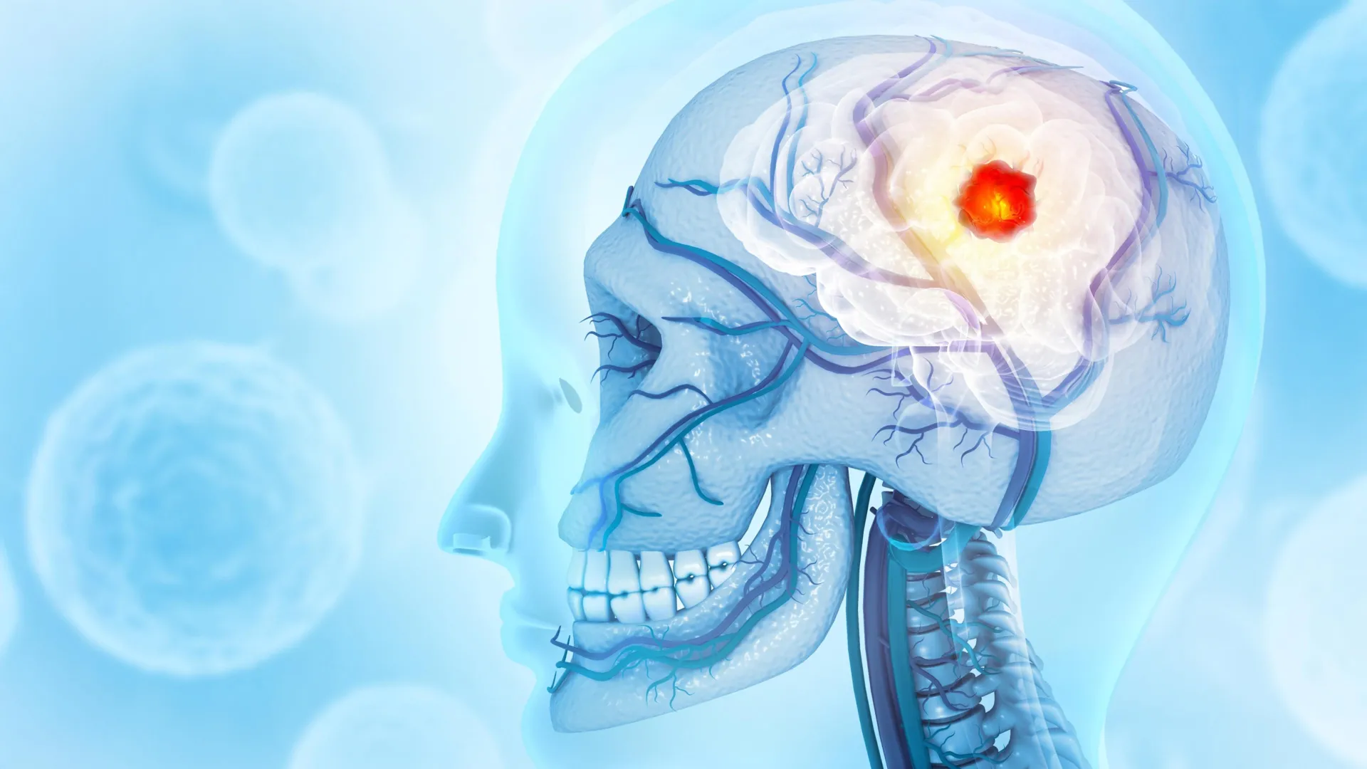 Brain Tumors Induce Widespread Disruption of Calvarial Bone and Alteration of Skull Marrow Immune Landscape 1 brain tumors induce widespread disruption of calvarial bone and alteration of skull marrow immune landscape