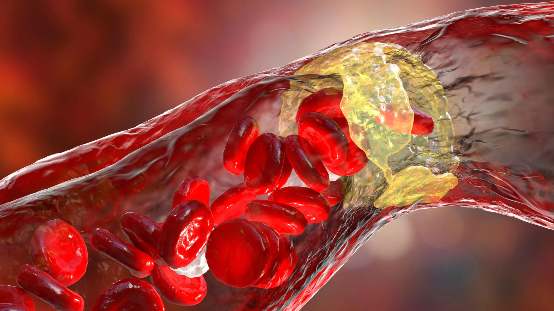 powerful cholesterol drug cuts heart attack risk by 31