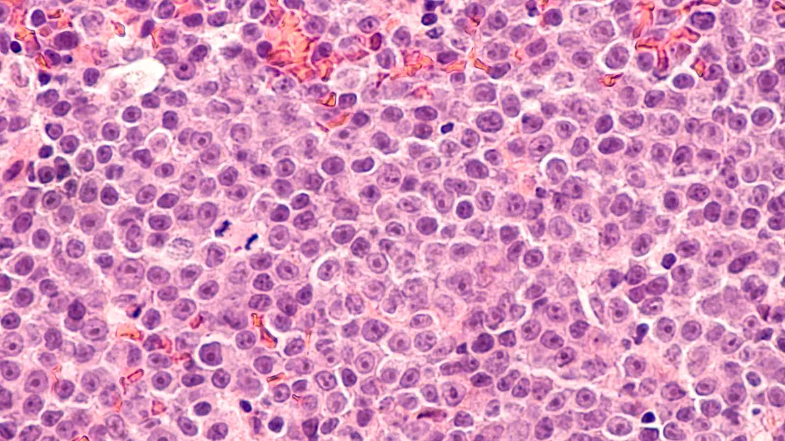 legend biotechs in vivo car t therapy lb2501 achieves full remissions in initial lymphoma trial signaling a potential paradigm shift in cell therapy