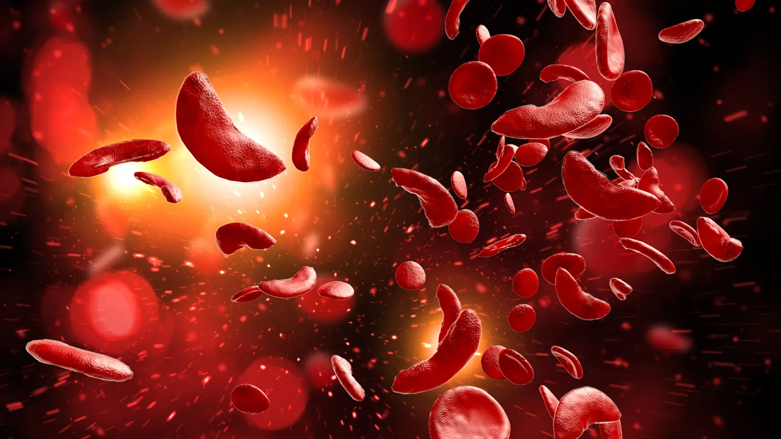 agios pharmaceuticals faces setback as tebapivat study fails highlighting persistent challenges in sickle cell disease drug development