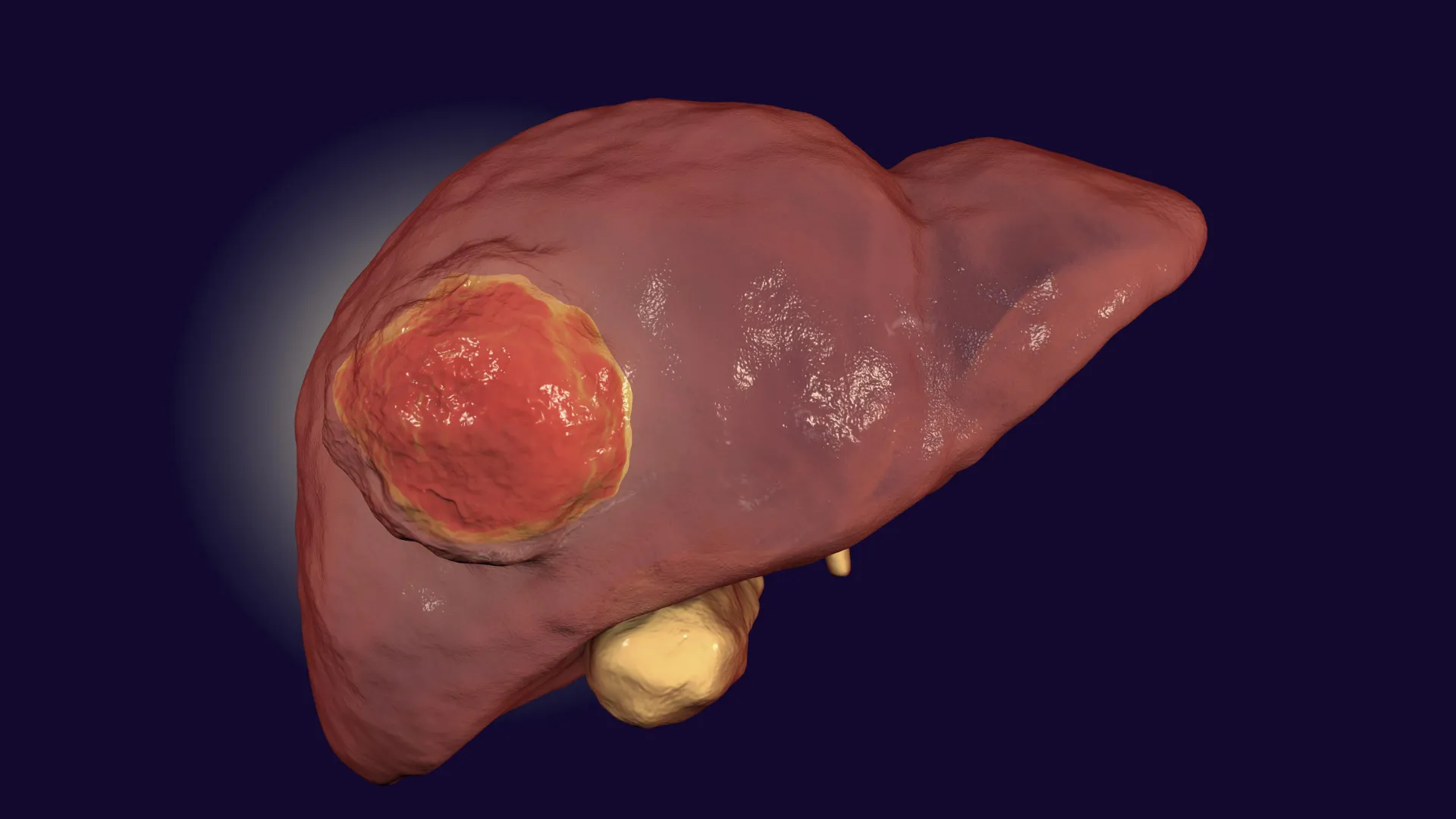 a breakthrough in treating fibrolamellar carcinoma repurposing an fda approved drug to overcome immunotherapy resistance