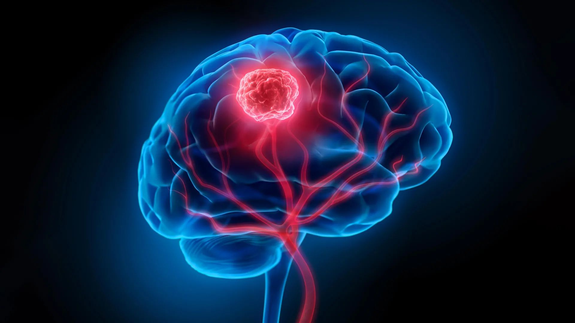 idh mutant glioma new research uncovers hidden origins in normal brain cells revolutionizing understanding of adult brain cancer