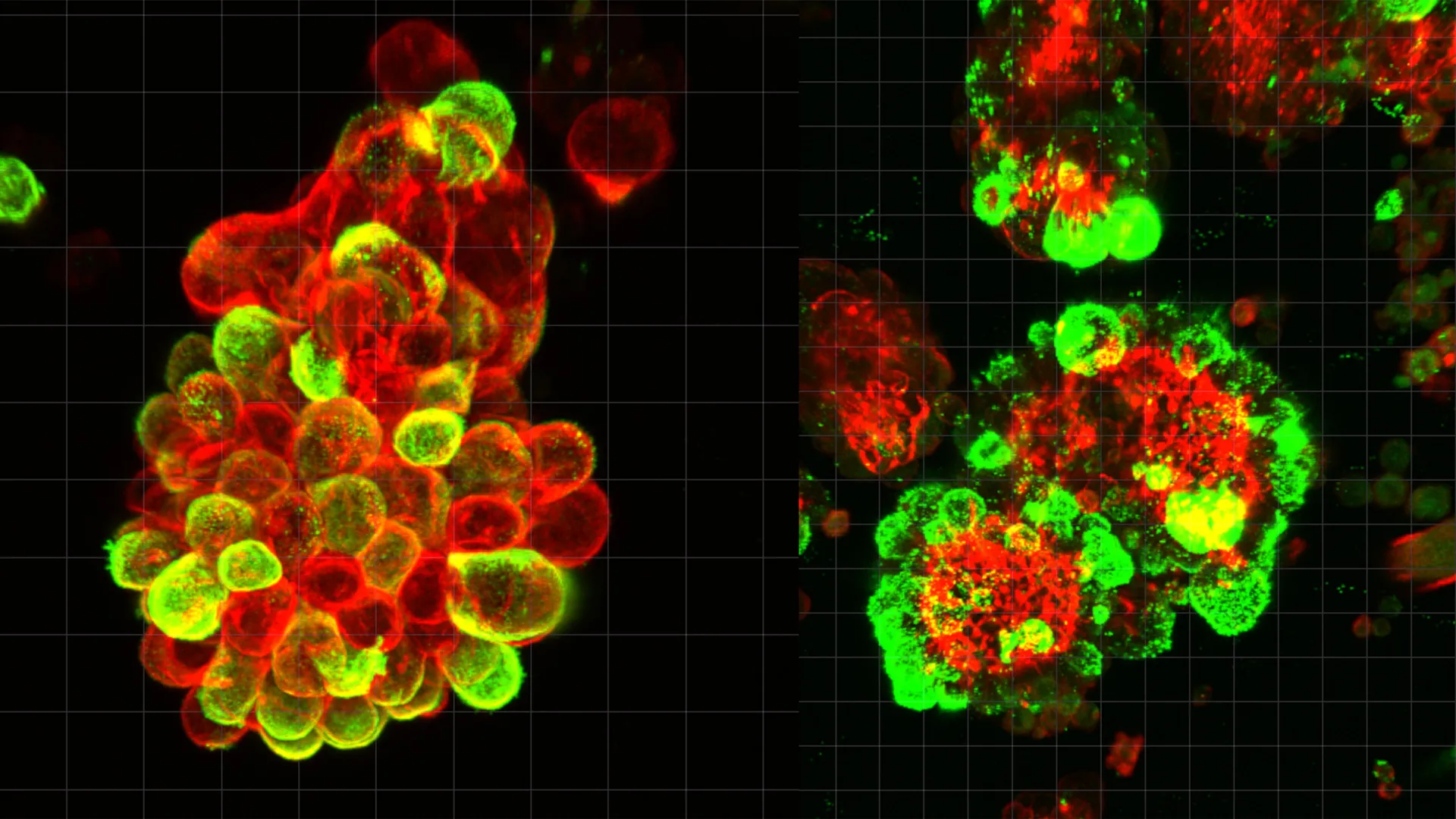 ovarian cancers secret accomplice study reveals how hybrid cell clusters drive rapid metastasis and chemoresistance