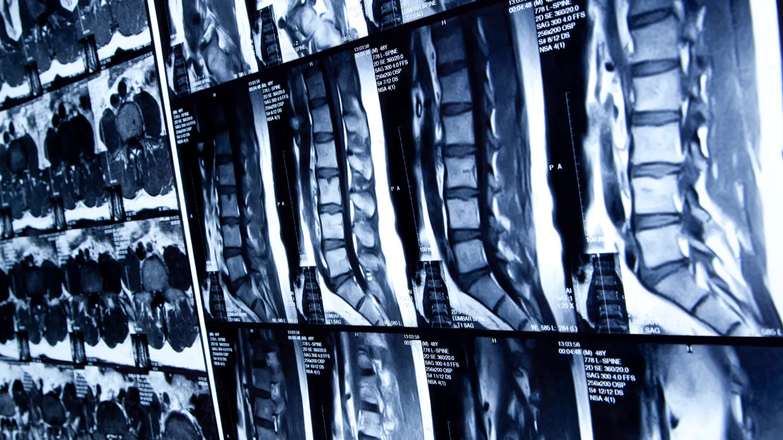 regeneron to challenge ipsen as fda clears bone disease drug