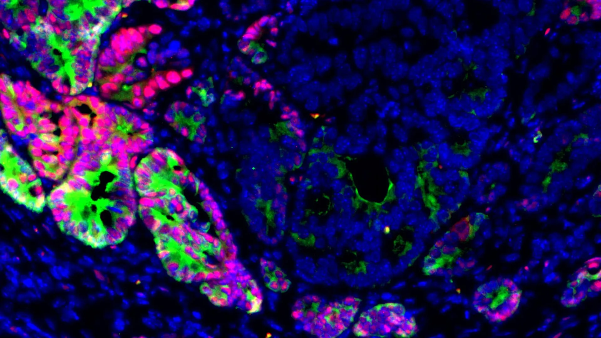 Scientists discover how colon cancer cells change identity to spread 1 scientists discover how colon cancer cells change identity to spread