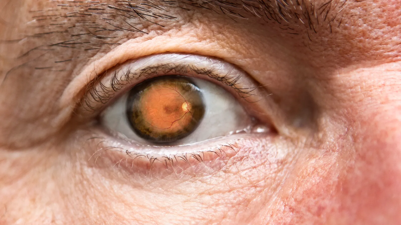 Tarsus Pharmaceuticals Acquires Alkeus Pharmaceuticals in Up to $800 Million Deal, Advancing Stargardt Disease Treatment 1 tarsus pharmaceuticals acquires alkeus pharmaceuticals in up to 800 million deal advancing stargardt disease treatment