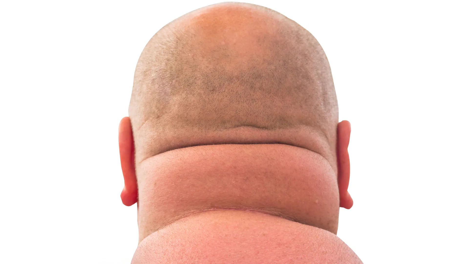 the neck circumference an unconventional yet potent indicator of hidden health risks