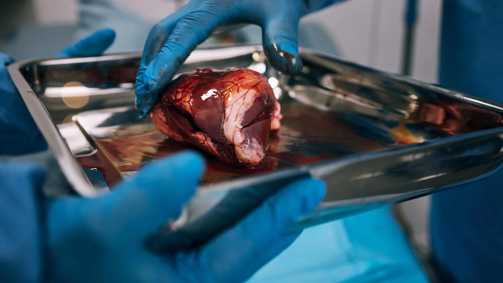 the stark reality nearly half of americans referred for kidney transplants never start the evaluation process