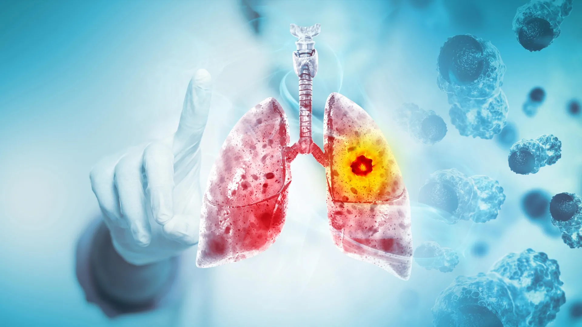 why are healthy young non smokers developing lung cancer 1