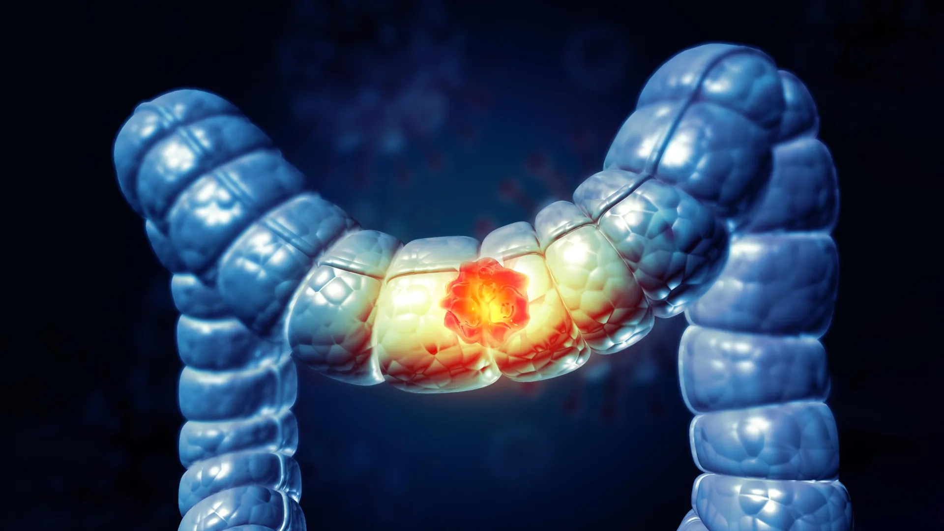 Why colorectal cancer breaks the immune system’s rules 1 why colorectal cancer breaks the immune systems rules