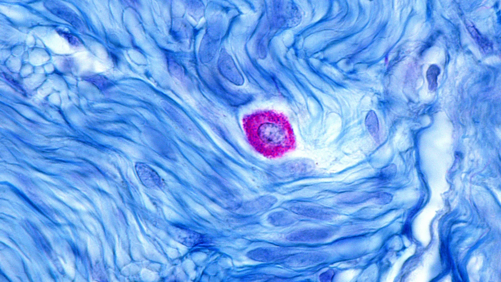 Barzolvolimab Shows Unprecedented Efficacy in Chronic Hives but Raises Safety Questions with Anaphylaxis Cases 1 barzolvolimab shows unprecedented efficacy in chronic hives but raises safety questions with anaphylaxis cases