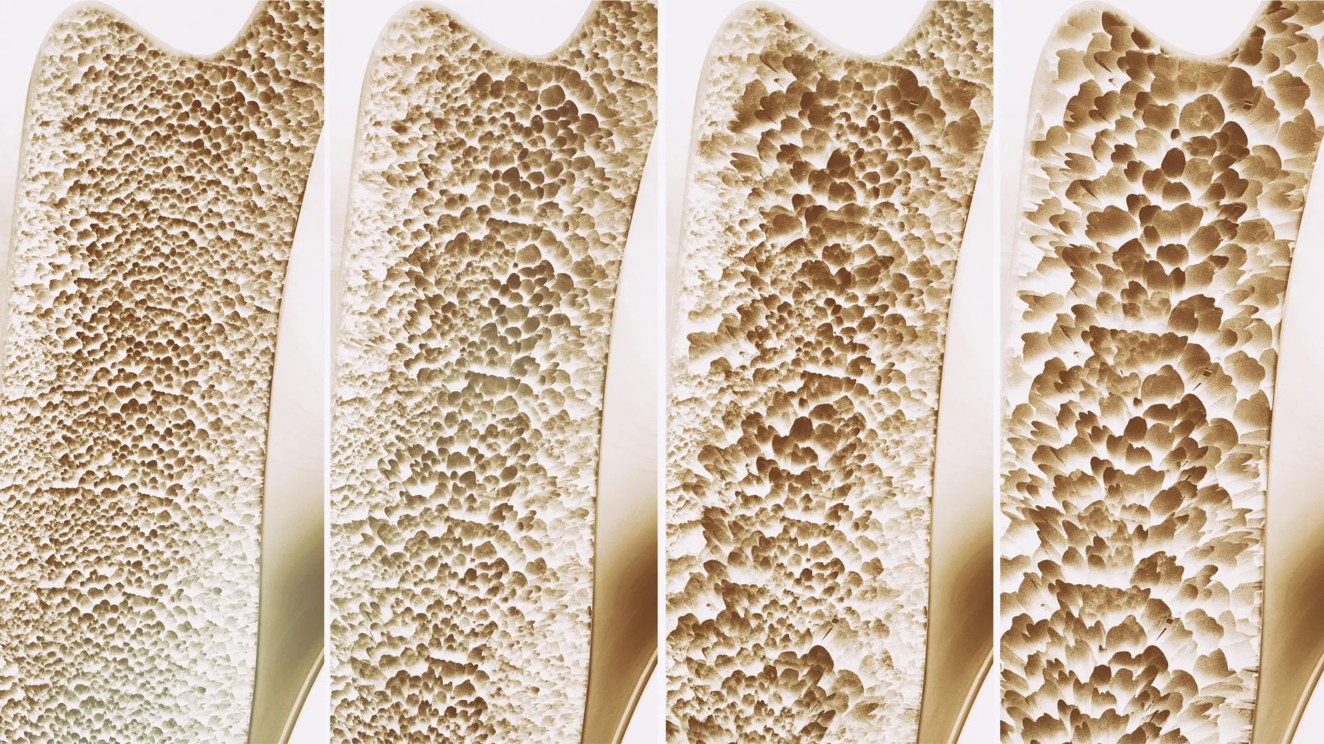 leipzig university uncovers gpr133 as novel therapeutic target for osteoporosis offering dual benefit for bone and muscle strength