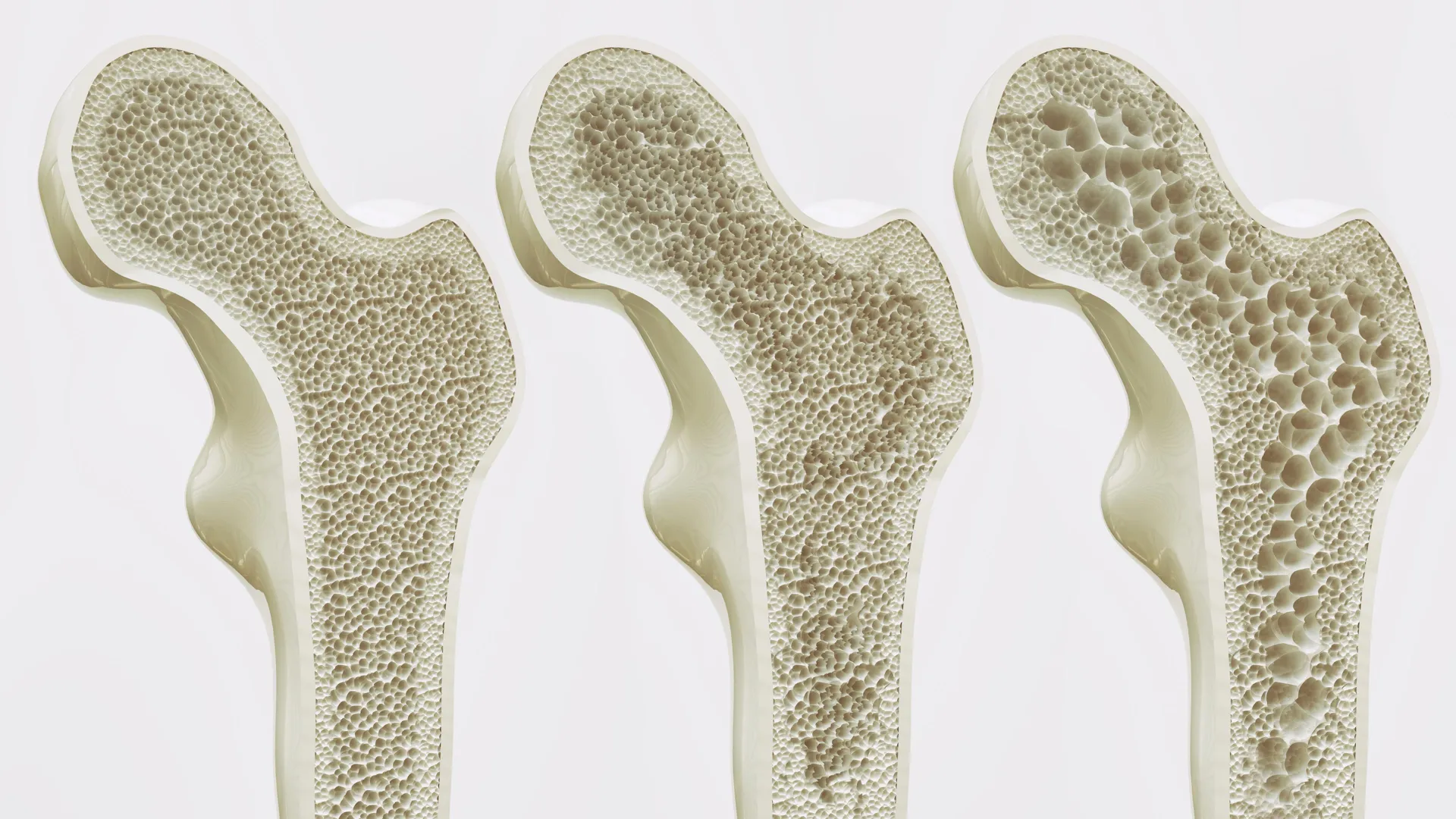 routine calcium and vitamin d supplementation offers little benefit against falls and fractures for most older adults major review concludes