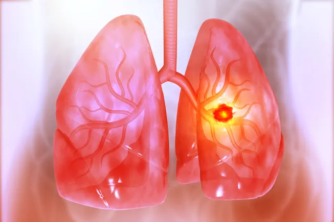 world conference on lung cancer highlights advancements in targeted therapies adc innovations and global trial scrutiny