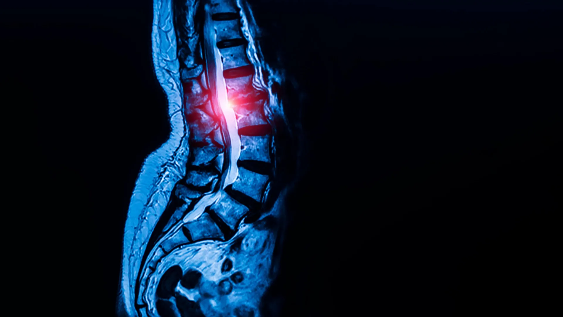 Researchers Discover Crucial Stem Cell Population Responsible for Tendon and Ligament Formation, Offering New Hope for Spinal Stenosis Treatment 1 researchers discover crucial stem cell population responsible for tendon and ligament formation offering new hope for spinal stenosis treatment