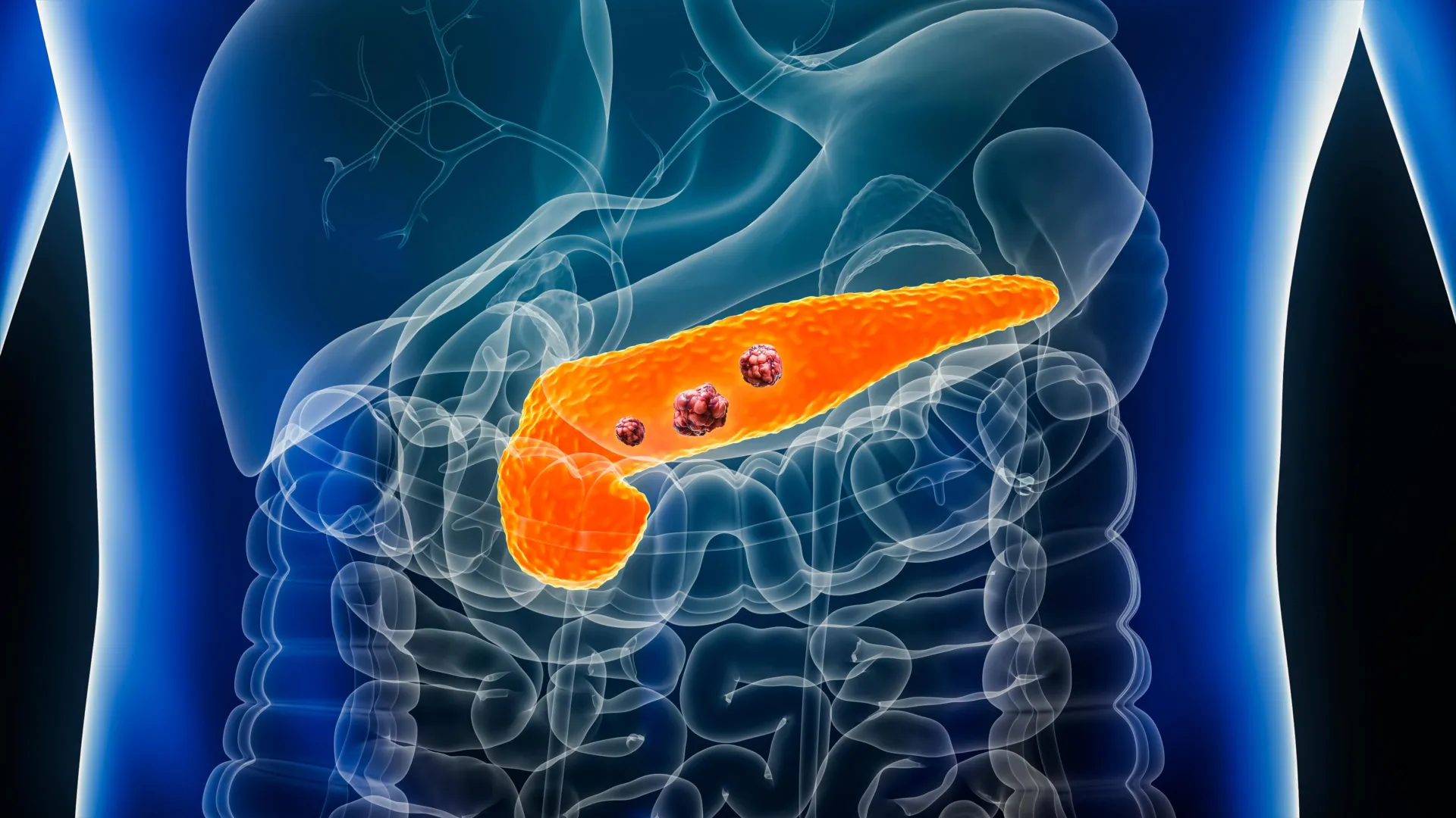 revolutionary ai model redmod detects pancreatic cancer years before clinical diagnosis outperforming human radiologists