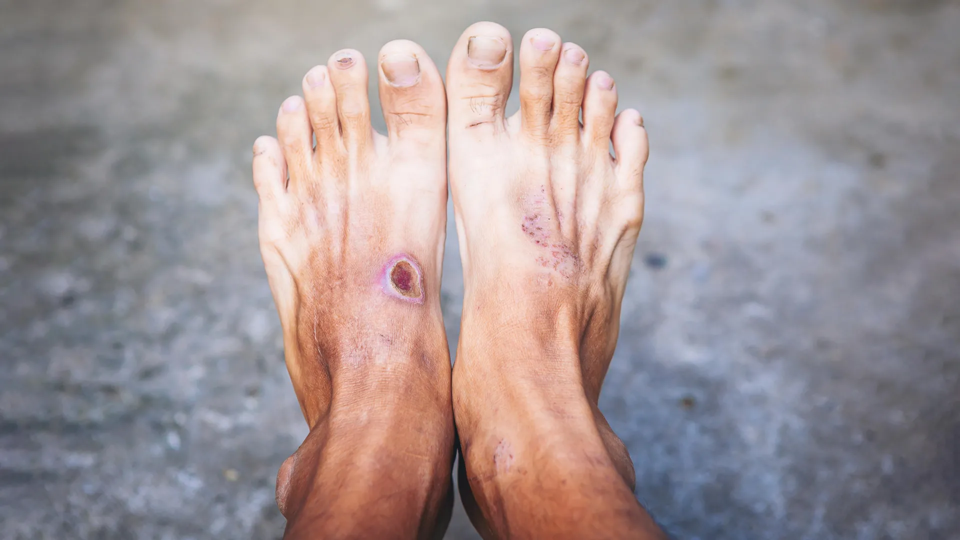 unraveling the immune systems role a critical review illuminates new pathways for healing chronic diabetic ulcers